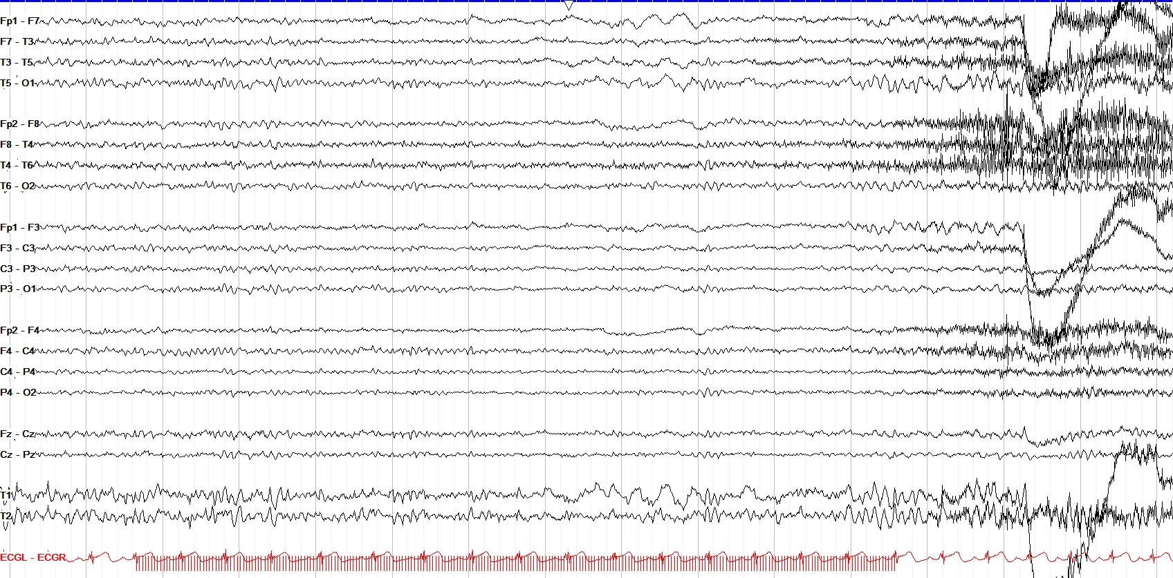 Photoconvulsive focal seizure