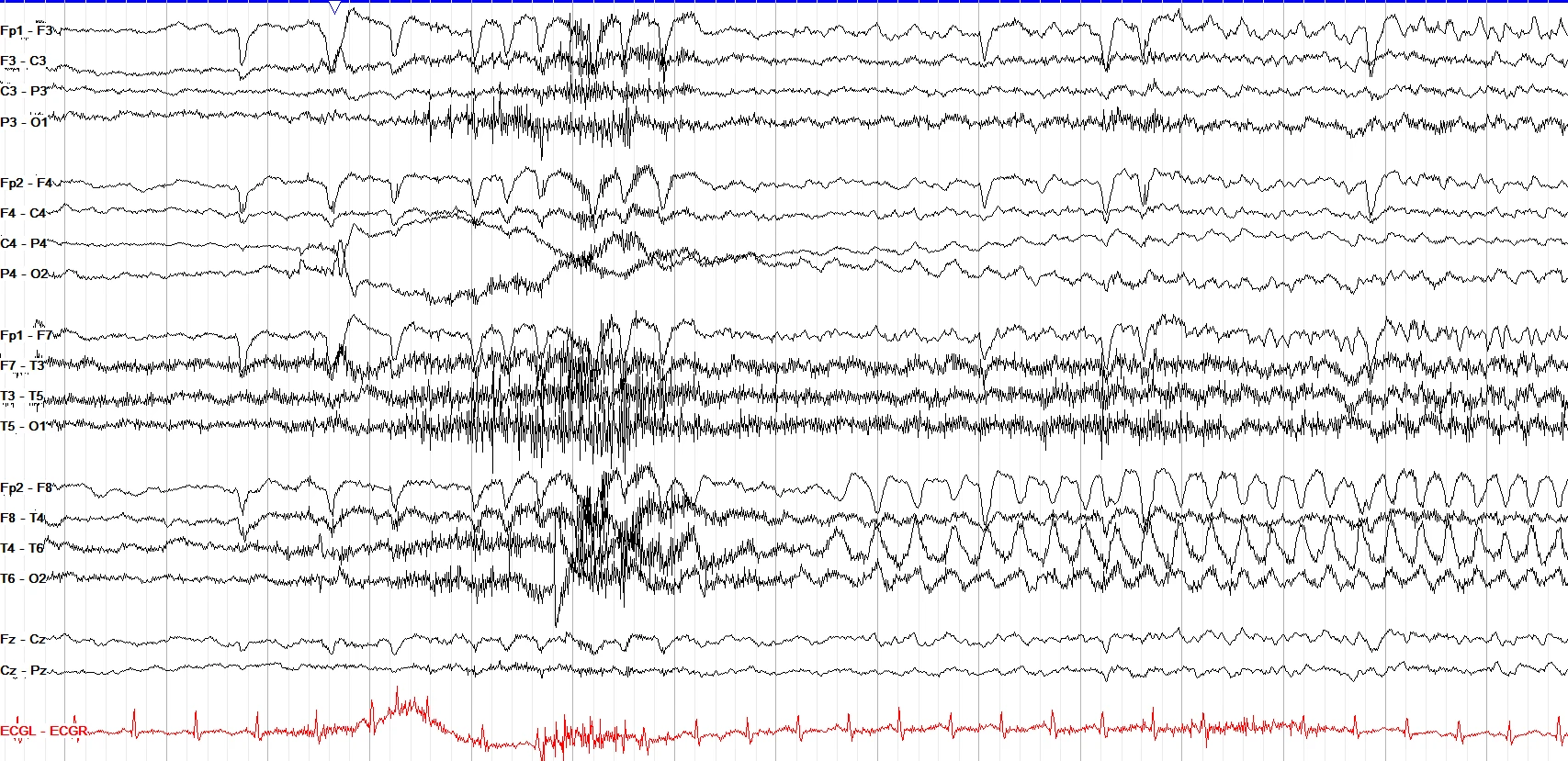 Right temporal to bilateral tonic clonic