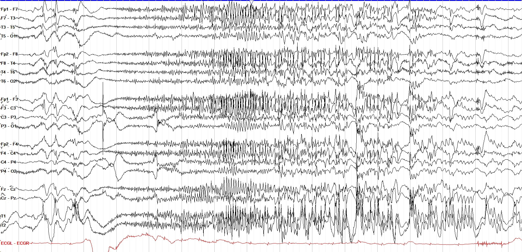 Tonic seizure I