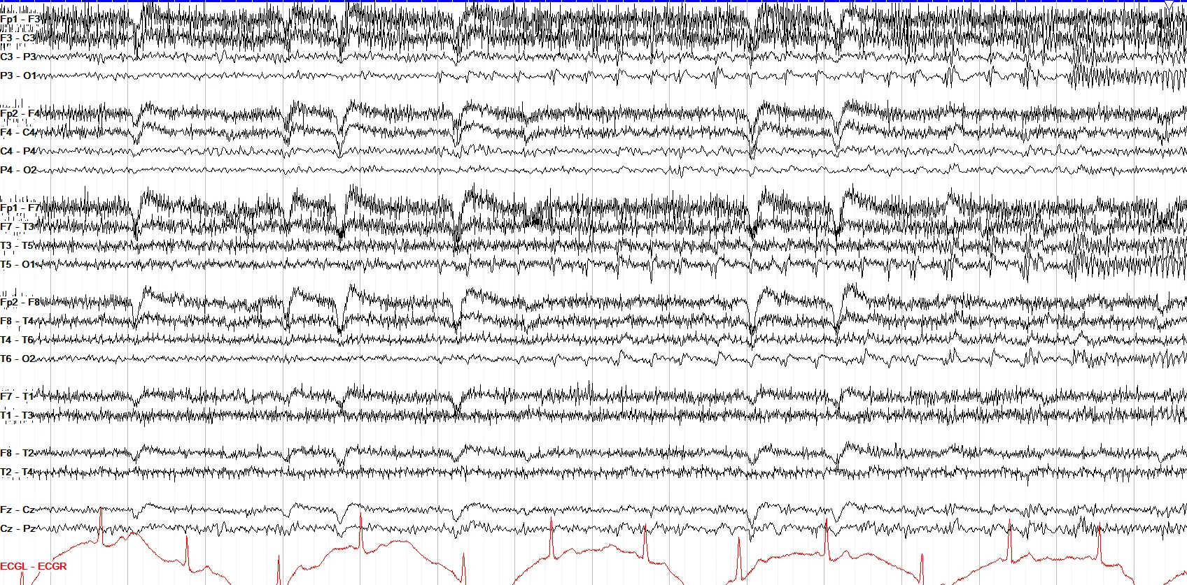Left occipital seizure, bipolar & circumferential