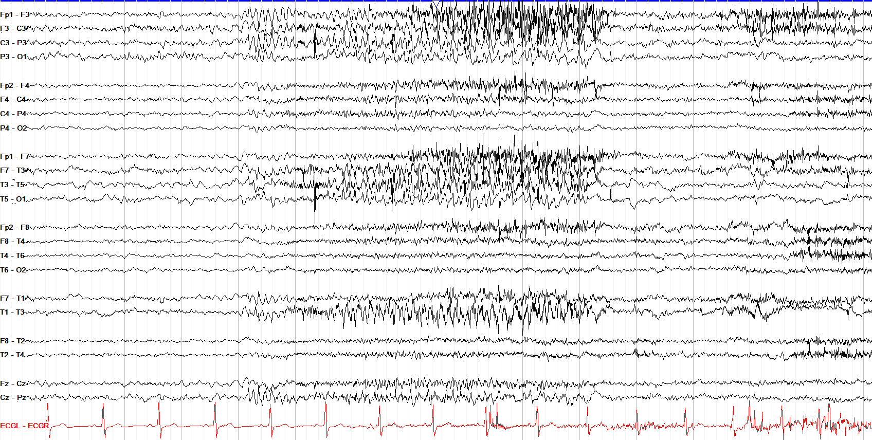 Test yourself - localize seizure onset