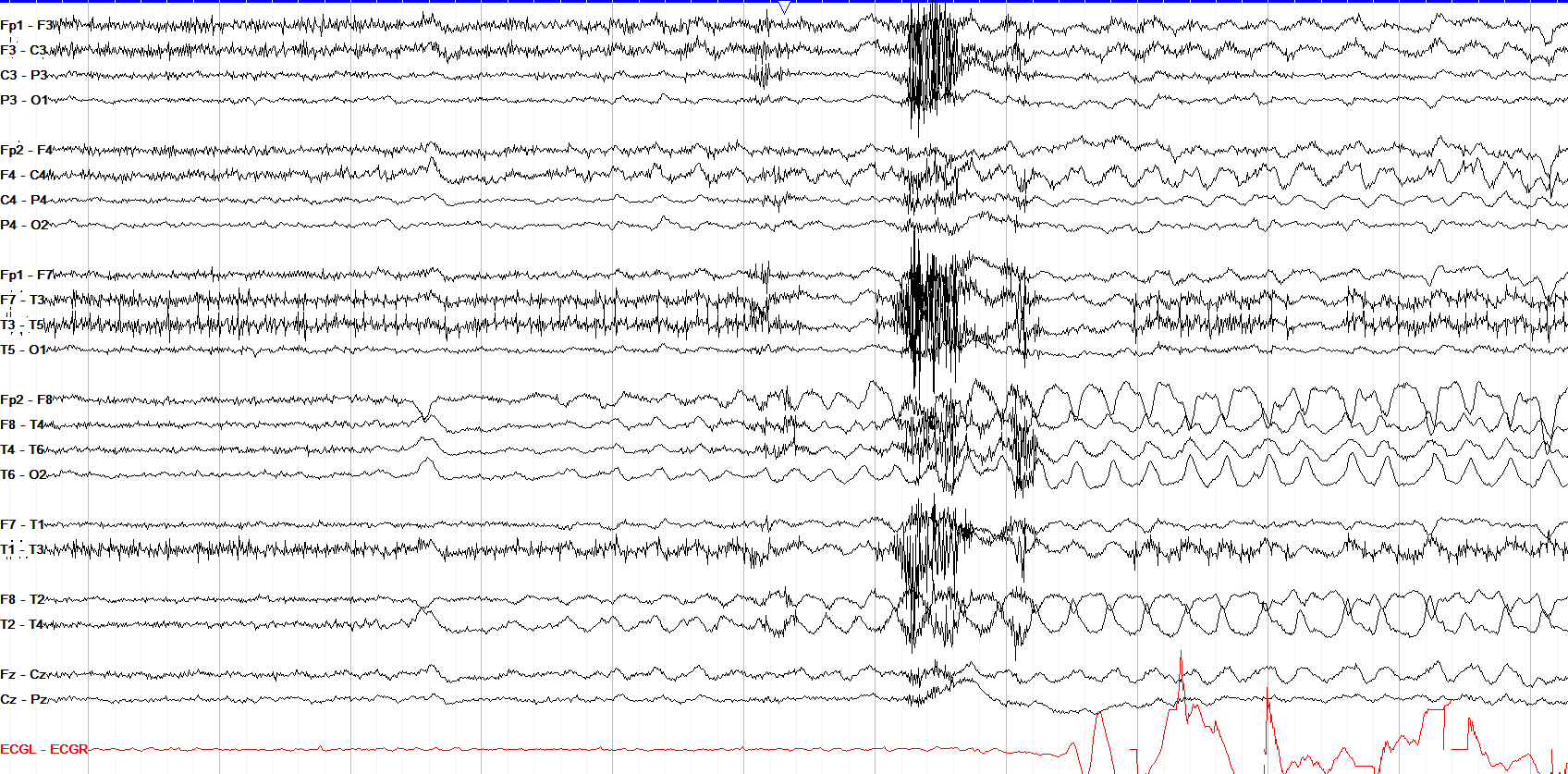 Test yourself - find seizure onset