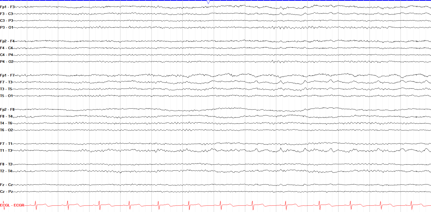 Test yourself - seizure or not?