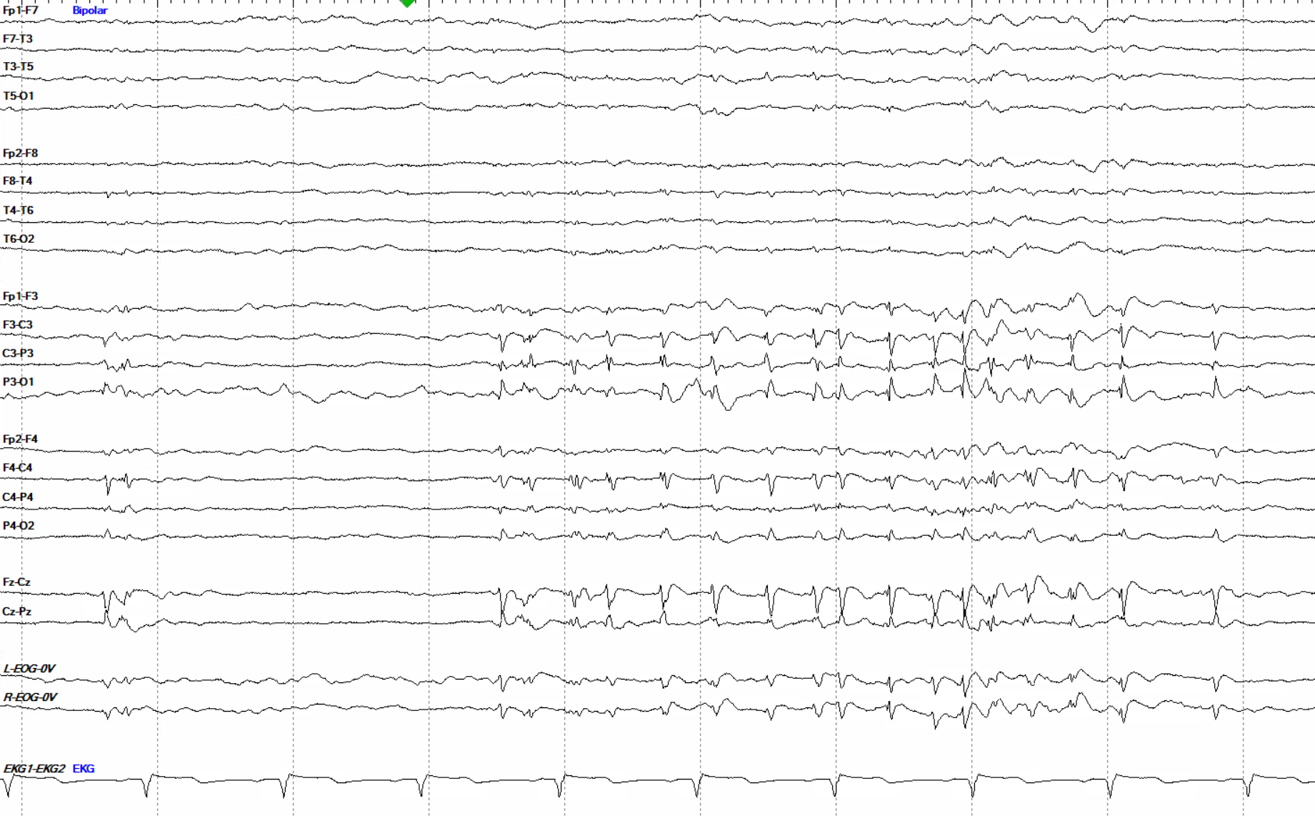 Test yourself - does this tracing show a seizure?