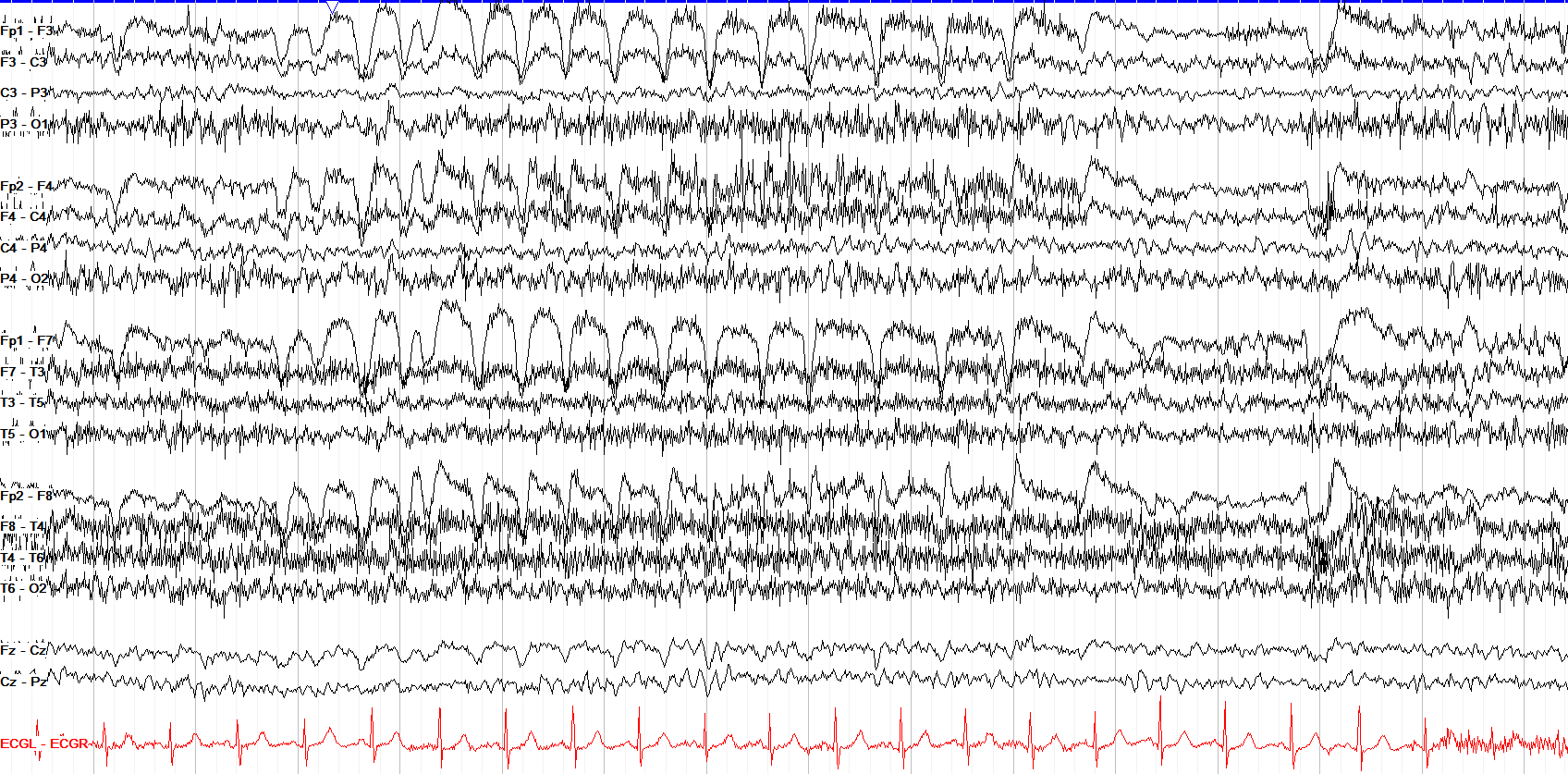 Test yourself - seizure or not?