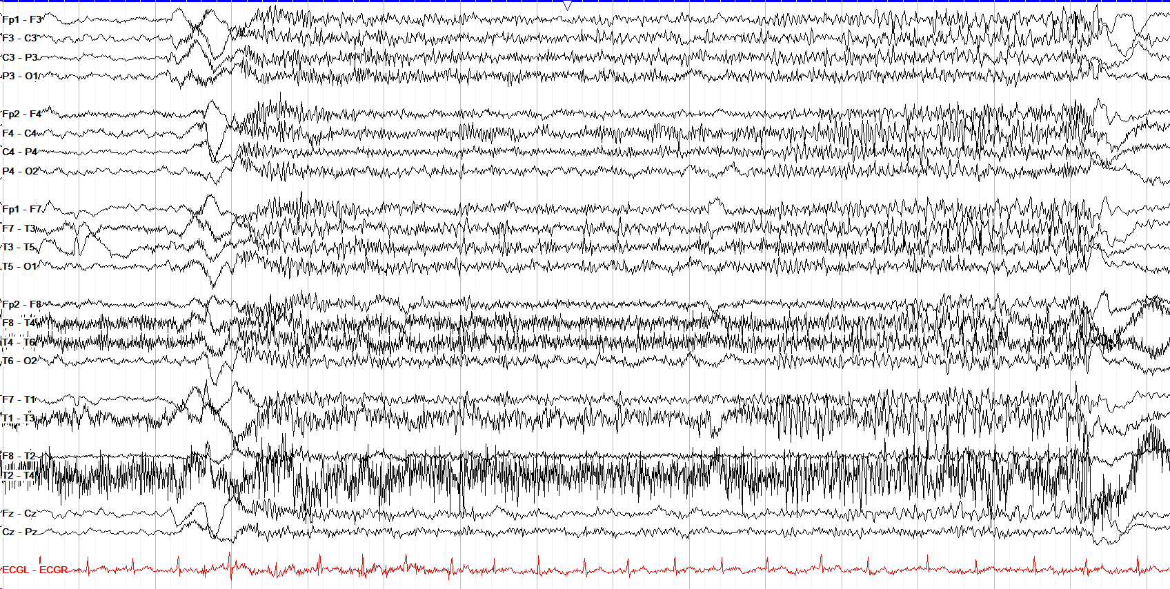 Tonic seizure with subtle left predominance, unannotated