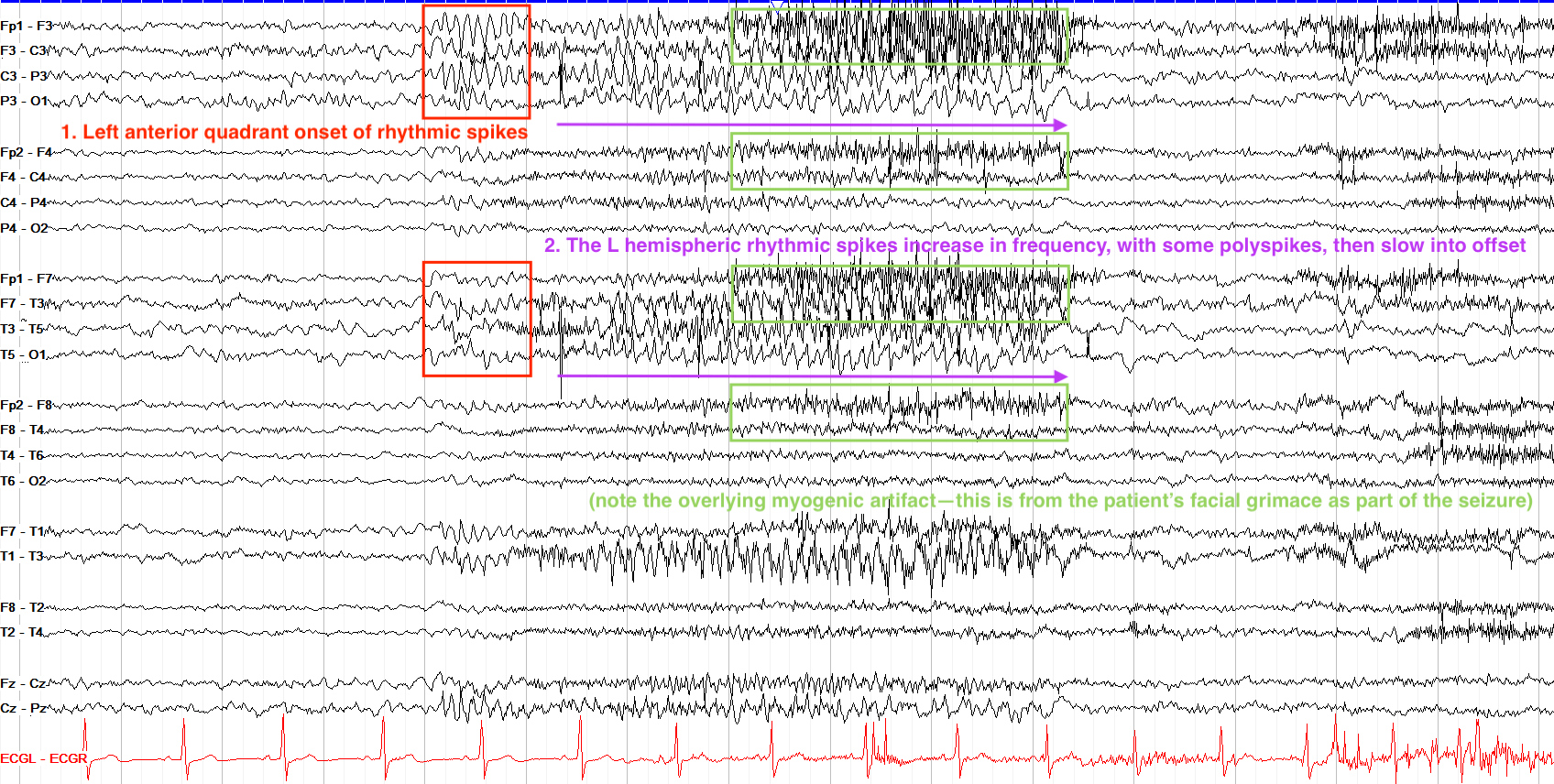 Answer - left anterior quadrant annotated