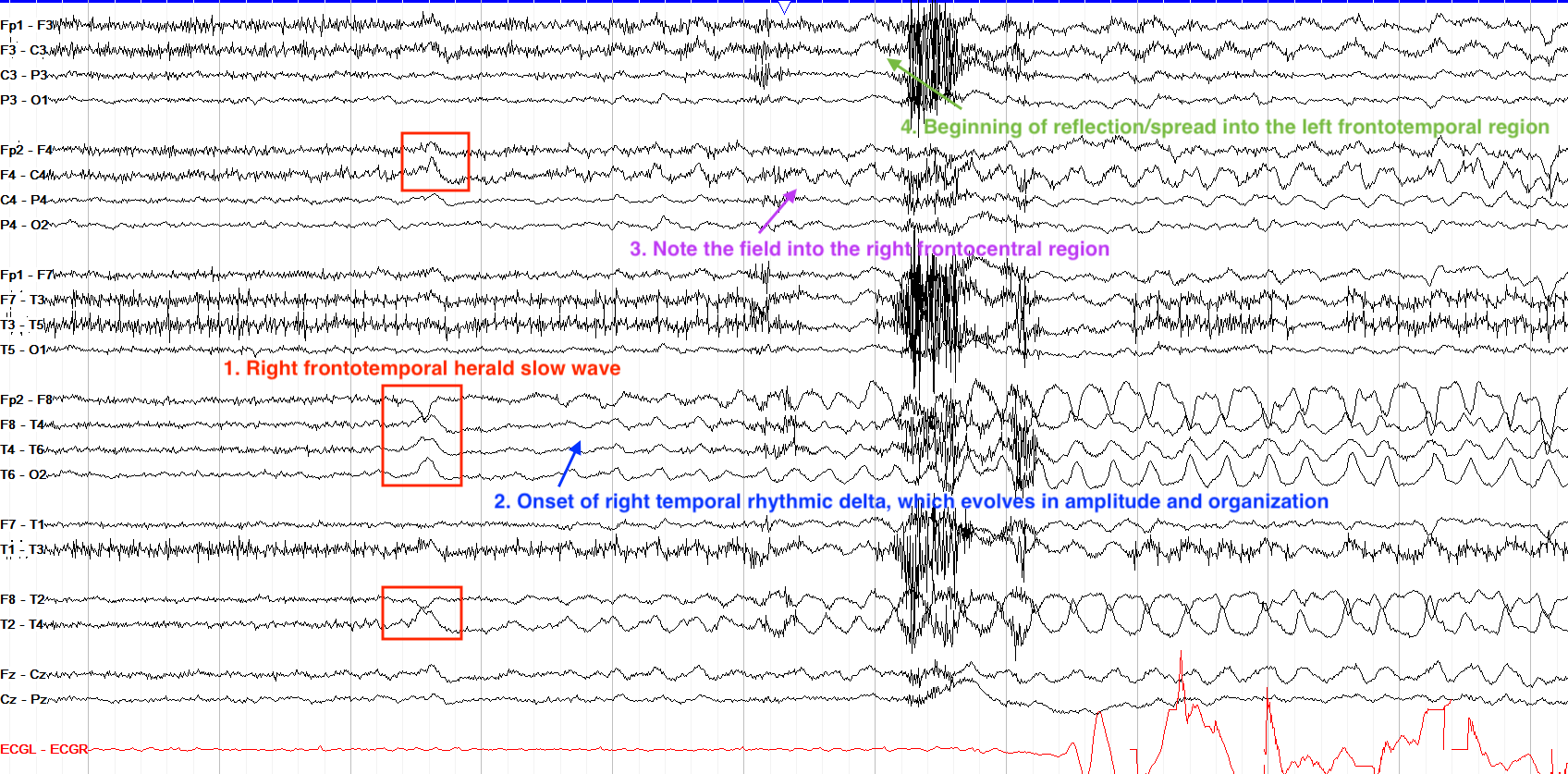 Answer - right frontotemporal annotated