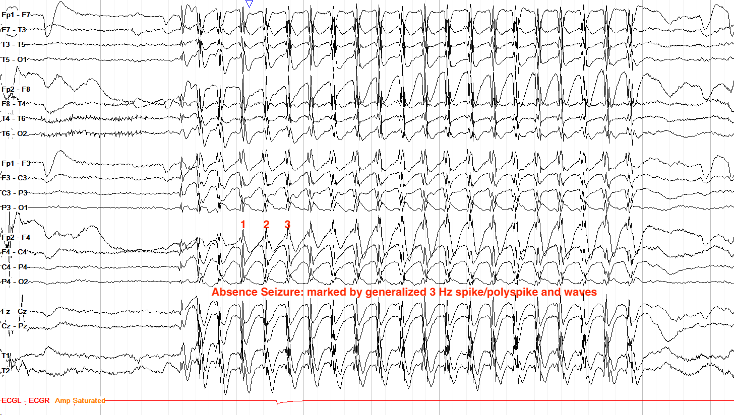 Absence seizure example