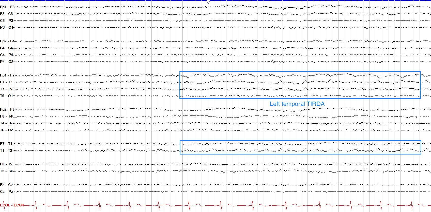 Answer - TIRDA annotated