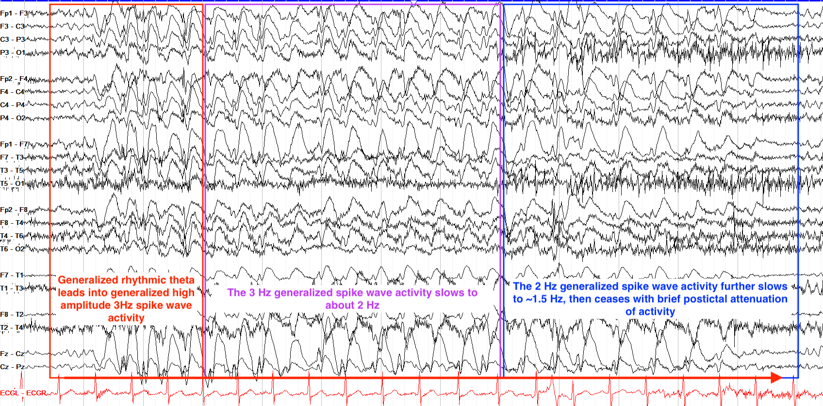 Generalized seizure example