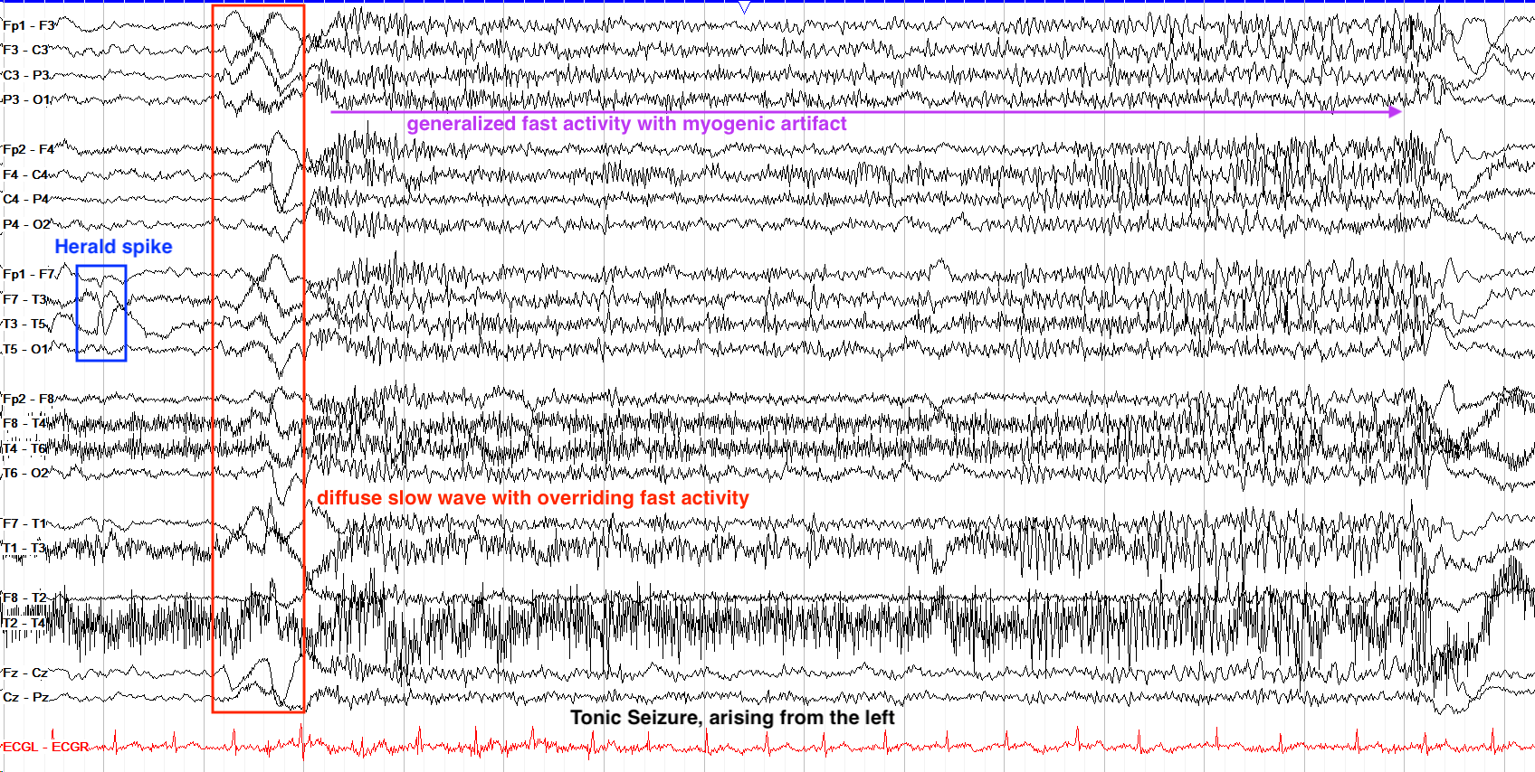 Tonic seizure with subtle left predominance, annotated