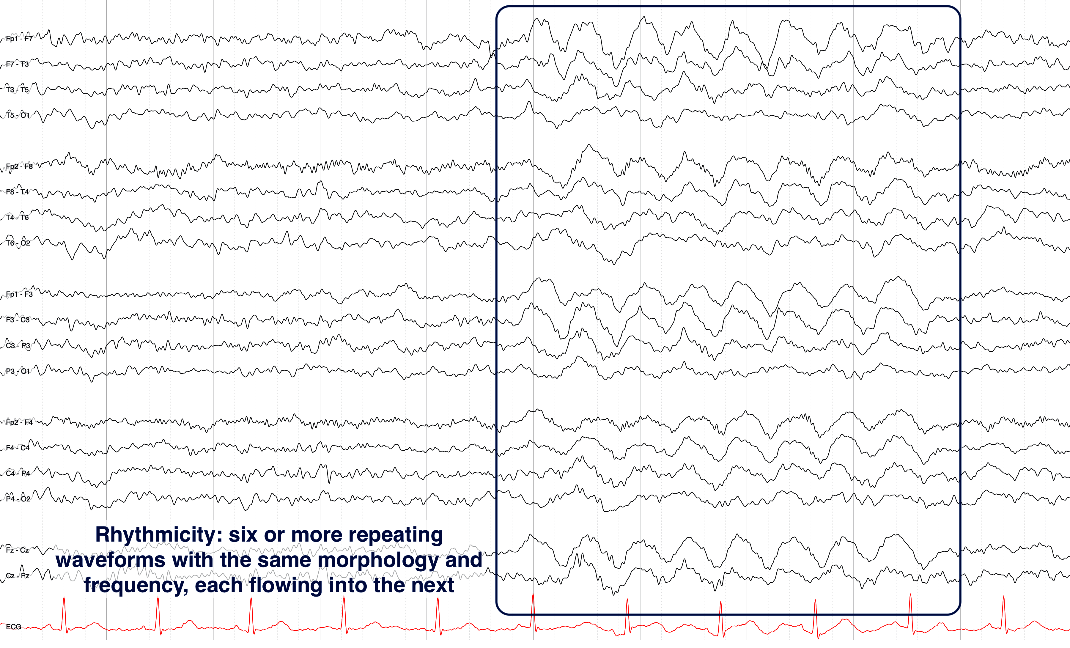 Rhythmicity: six or more repeating waveforms with the same morphology and frequency, each flowing into the next