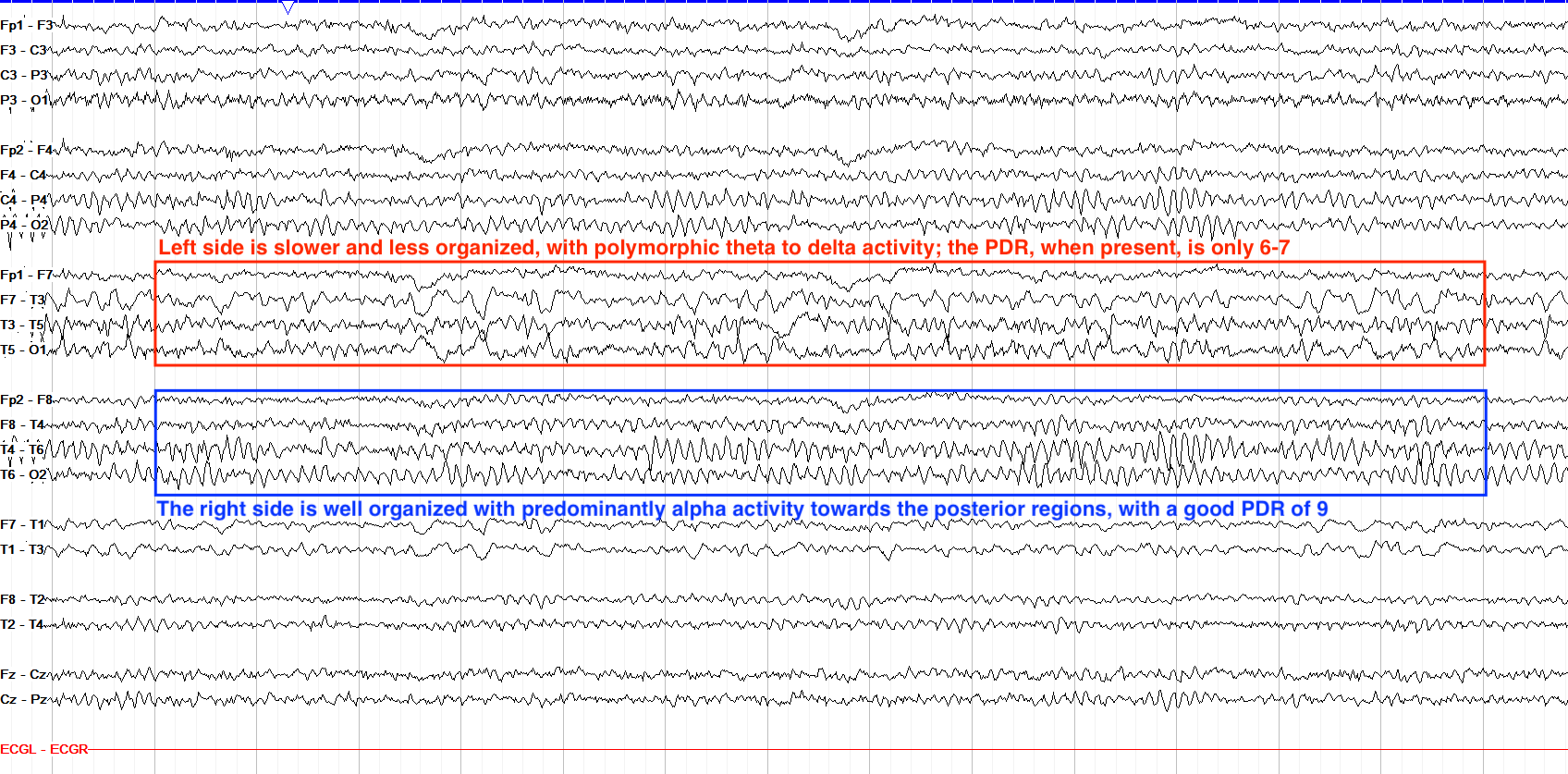 Left hemispheric slowing annotated