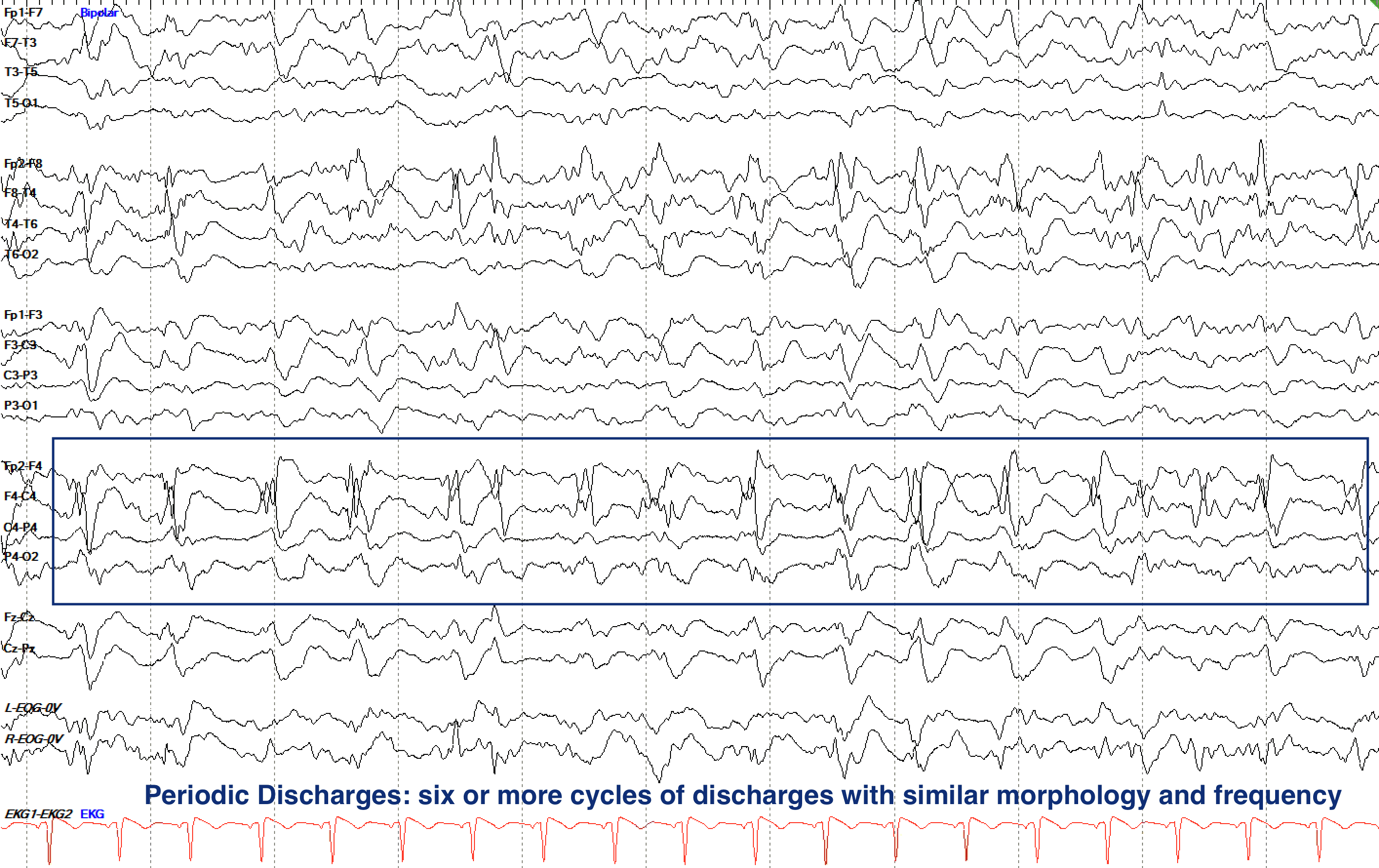 Periodic Discharges: six or more cycles of discharges with similar morphology and frequency