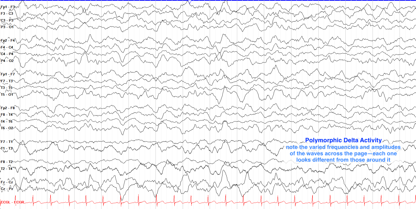 Polymorphic activity: waveforms vary in frequency and amplitude, each looking different from those around it