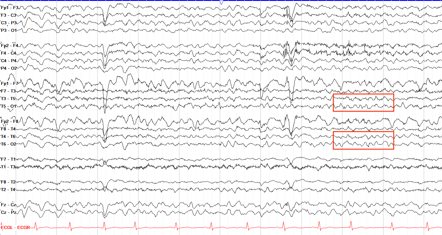Theta frequency waveform