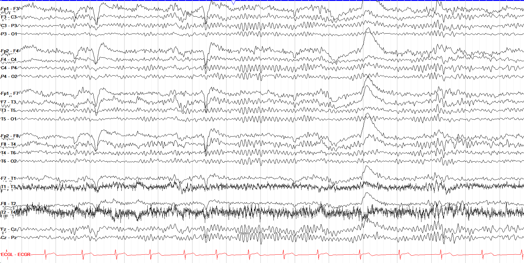 Real EEG example of alpha activity