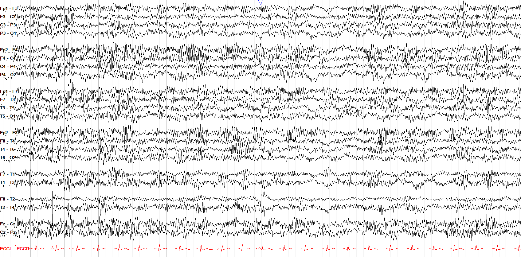 Real EEG example of beta activity