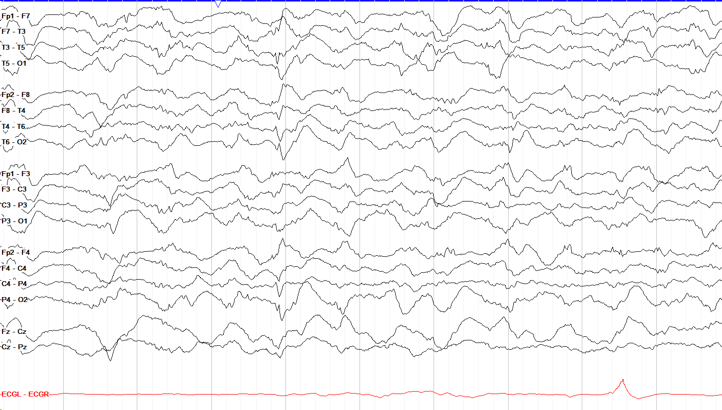 Real EEG example of delta-range slowing