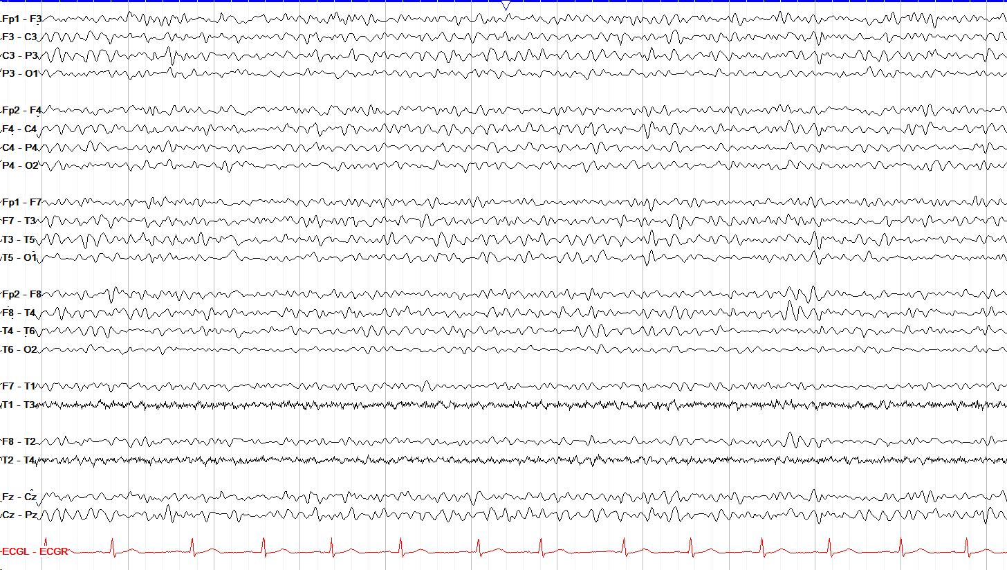 Real EEG example of theta activity