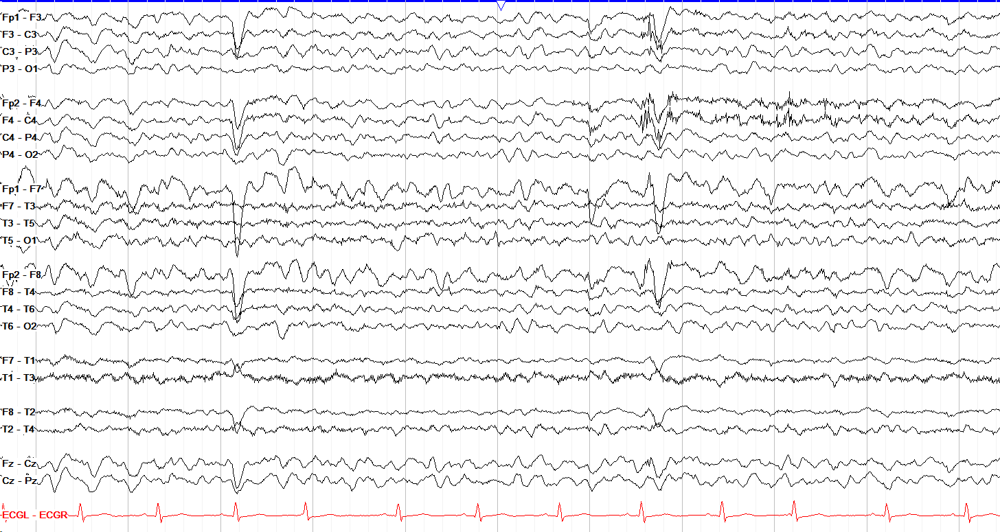 Theta Activity